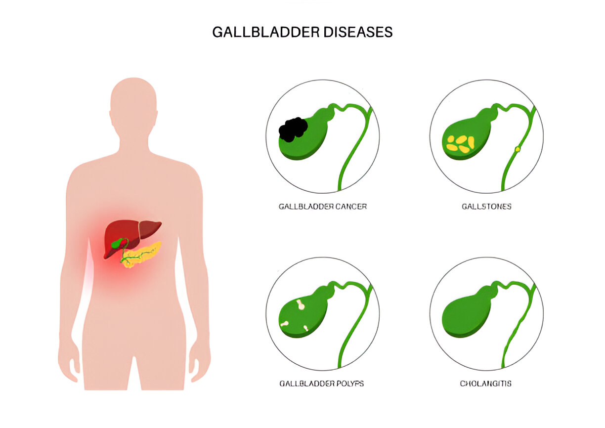 Best Gallbladder Stones Treatment In Andheri